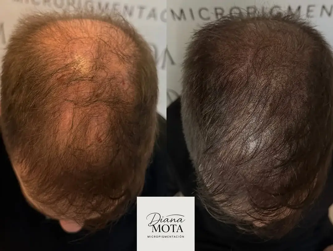 Antes: Postinjerto